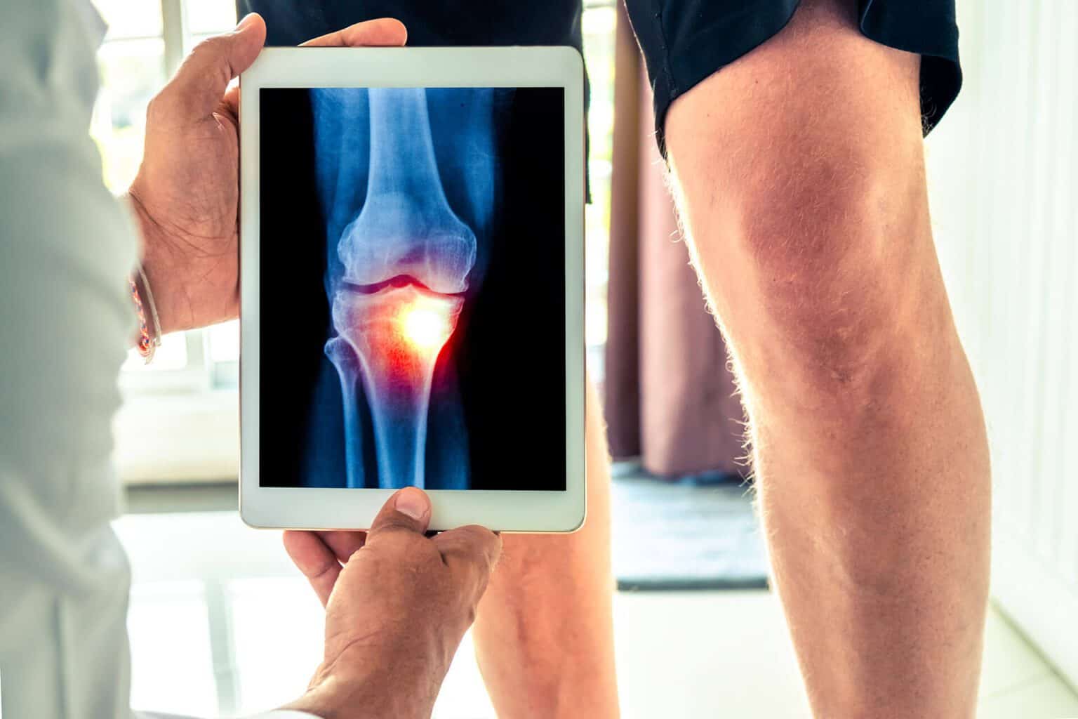 Knee Osteoarthritis How And Why To Avoid Knee Replacement Regenexx® At New Regeneration