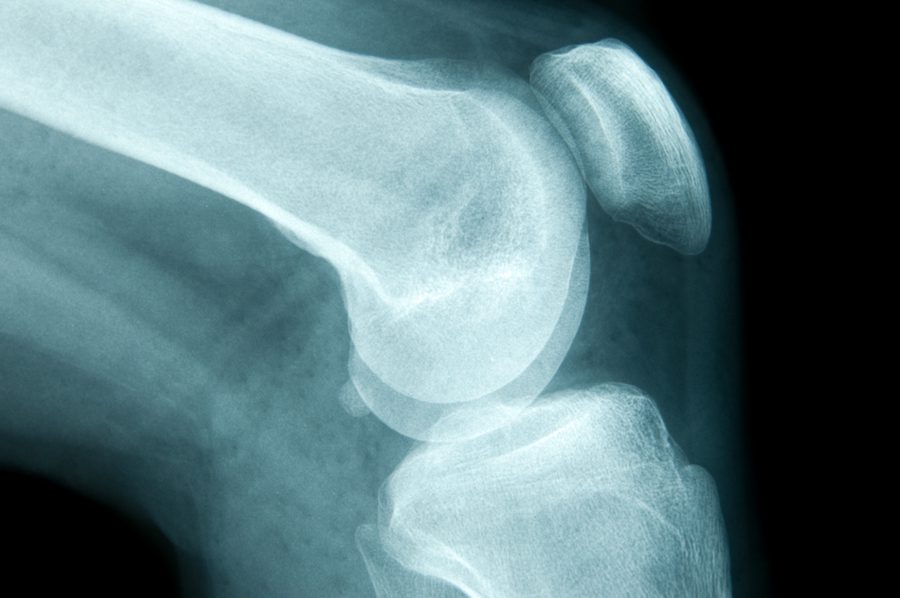 cartilage bone