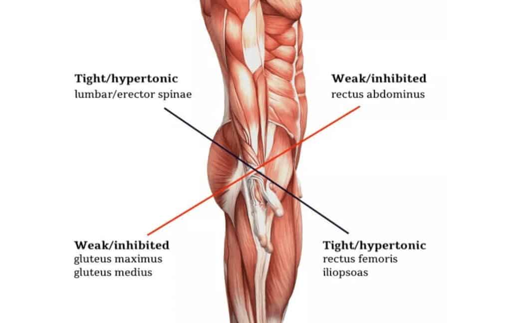 Gluteus Medius Tear - Heiden Orthopedics