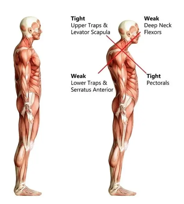 Muscle Therapy - Methods & How To Treat Your Own Neck & Back