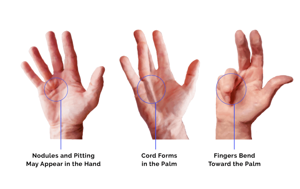 What Is Dupuytrens Contracture And How Can It Be Treated Regenexx