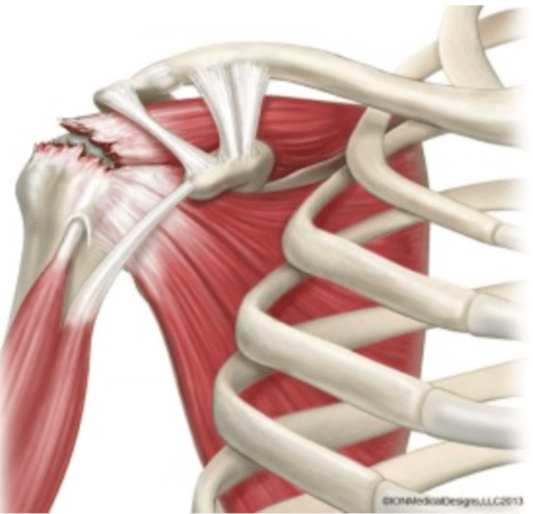 6 Reasons Why Your Shoulder is Clicking – Regenexx® at New Regeneration  Orthopedics